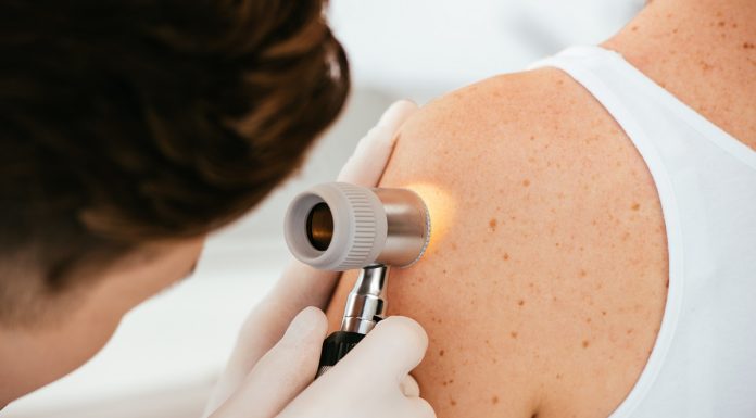 Un ghid pas cu pas pentru autoexaminarea cancerului de piele