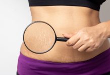 Vergeturile: Cauze, remedii si tratamente recomandate