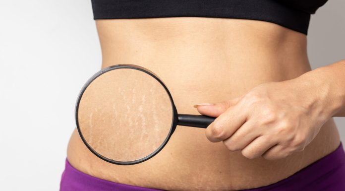 Vergeturile: Cauze, remedii si tratamente recomandate